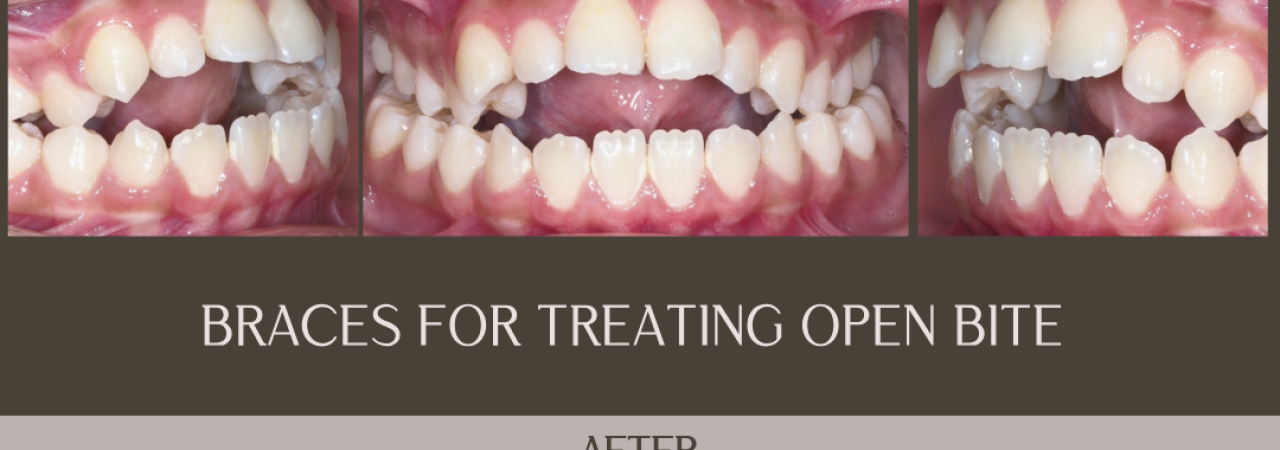 Braces - Open bite